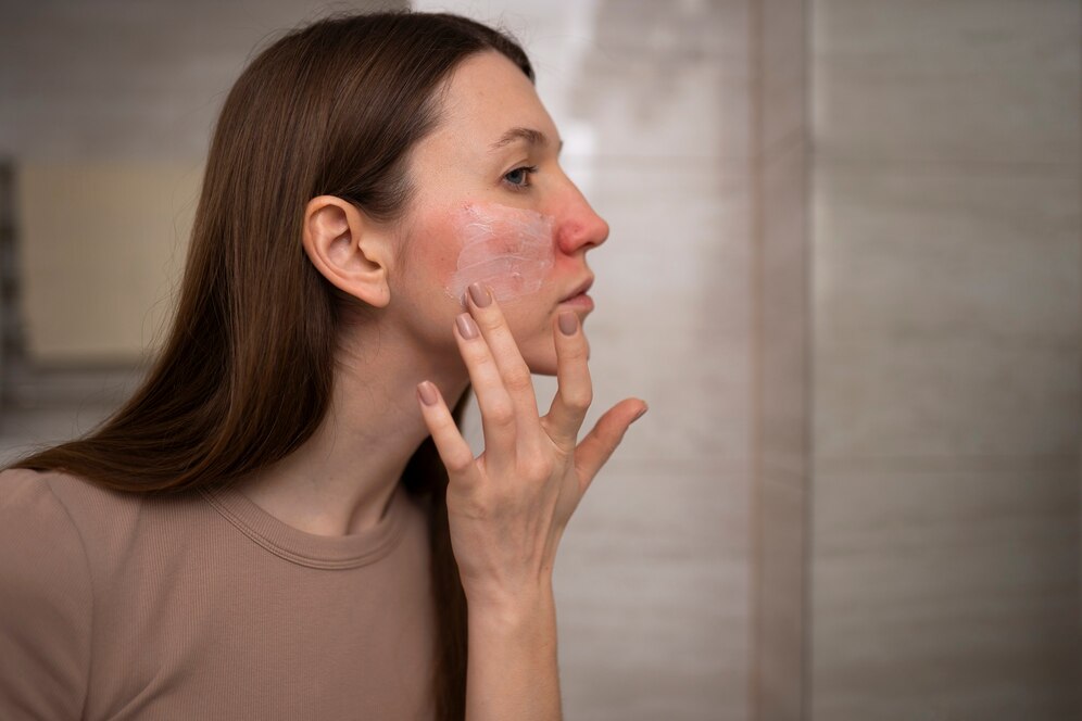 woman-using-moisturizer-help-with-rosacea-skin-condition_23-2150248364 مراقبت از پوست خشک و حساس: راهنمای کامل برای پوستی نرم و لطیف